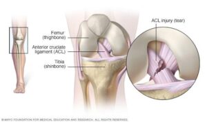 Main injury patterns for ACL injuries in female football players – BMJ Blogs