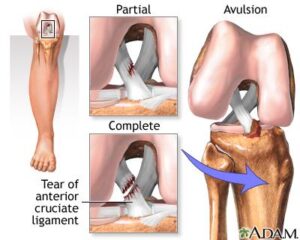 The ACL injury journey – a guide for patients – BMJ Blogs