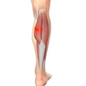 Medial Gastrocnemius Tears in Sports: Uncovering Whether Muscle, Aponeurosis, or Tendon Is to Blame